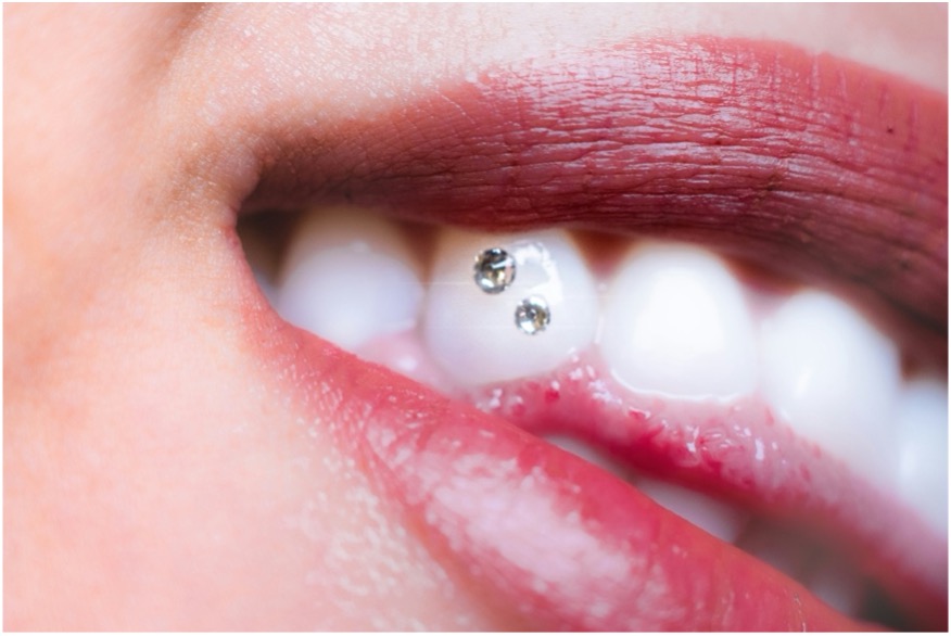 Joyas Dentales: La Última Tendencia en Estética Dental en Barcelona | Centro odontológico y formativo