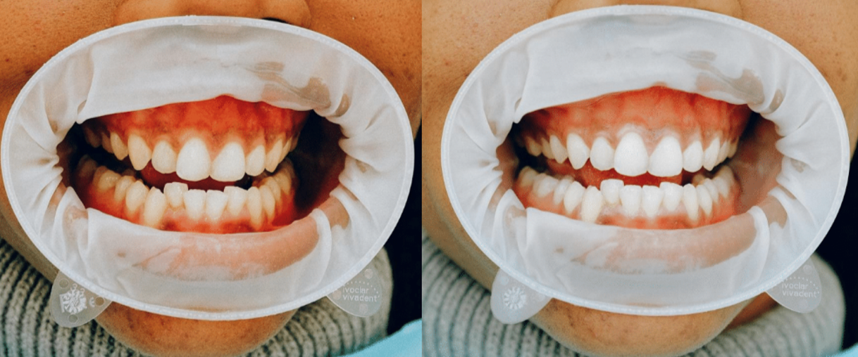 Blanqueamiento dental, ¿qué puedo esperar? | Centro odontológico y formativo