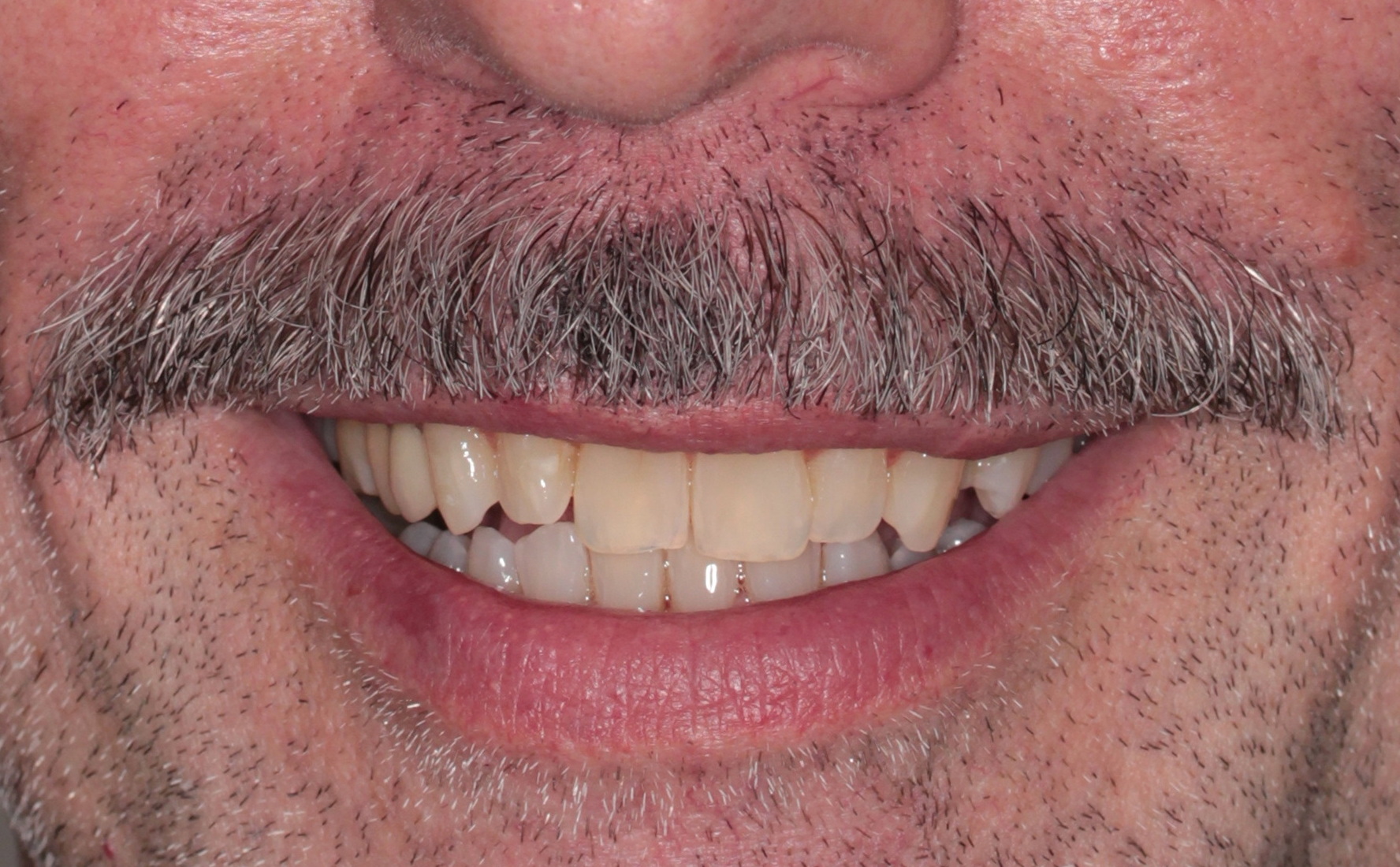 Caso Real: Transformación completa con ortodoncia, implantes y estética dental | Centro odontológico y formativo