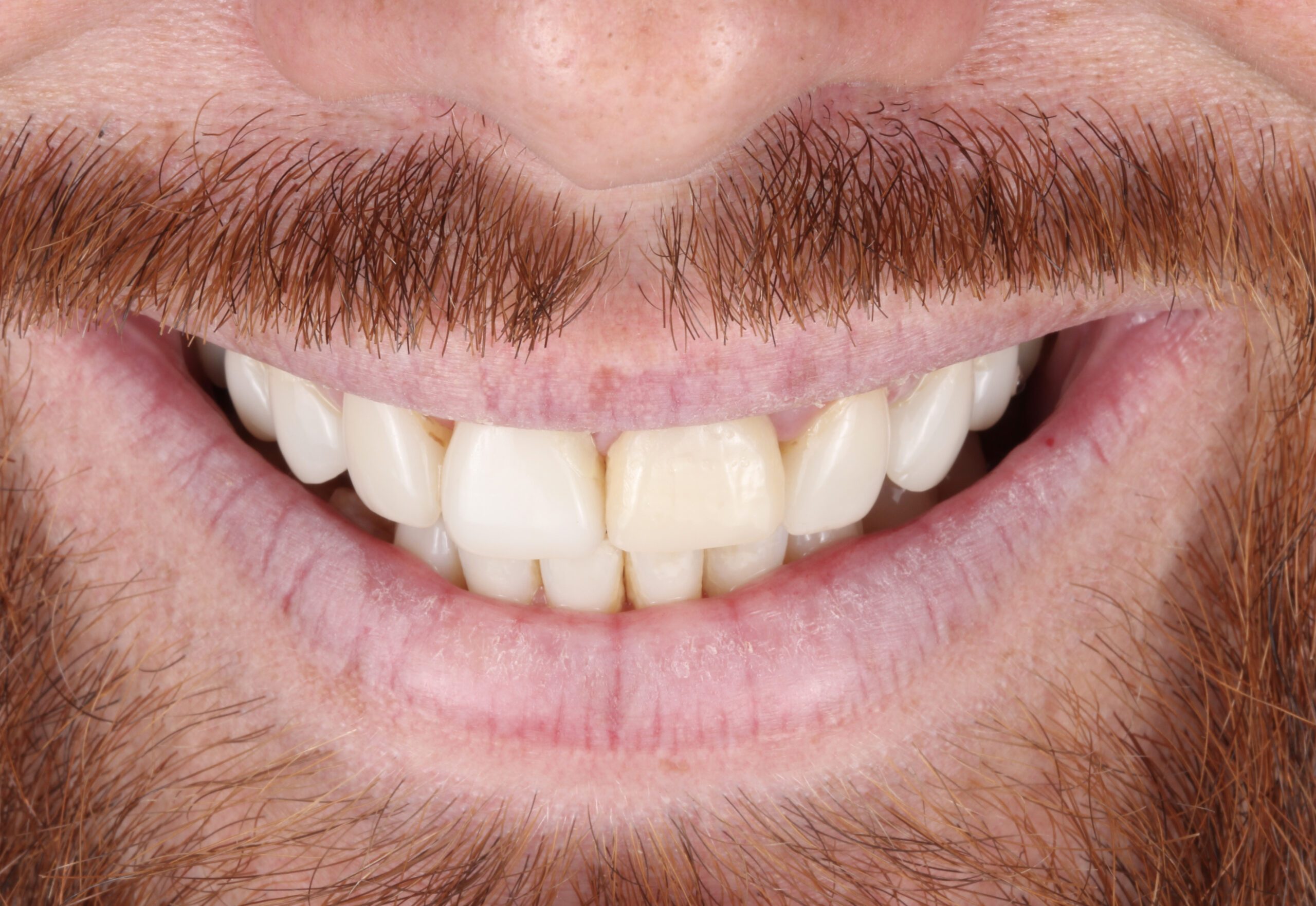 Cas Real: Renovació de carilles dentals per a un somriure saludable i natural | Centre odontològic i formatiu