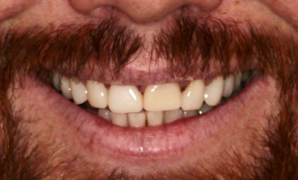 Cas Real: Renovació de carilles dentals per a un somriure saludable i natural | Centre odontològic i formatiu