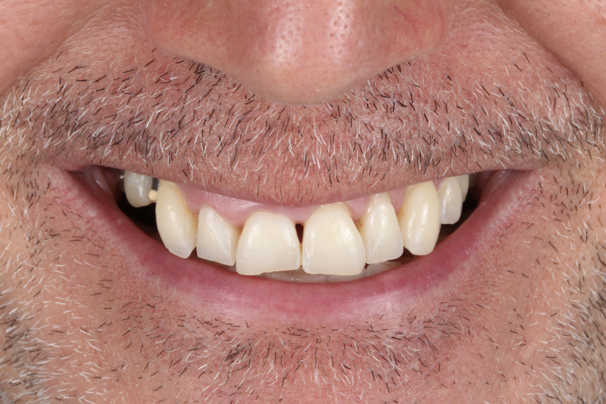 Caso real: Sonrisa renovada con ortodoncia, implantes y estética dental | Centro odontológico y formativo