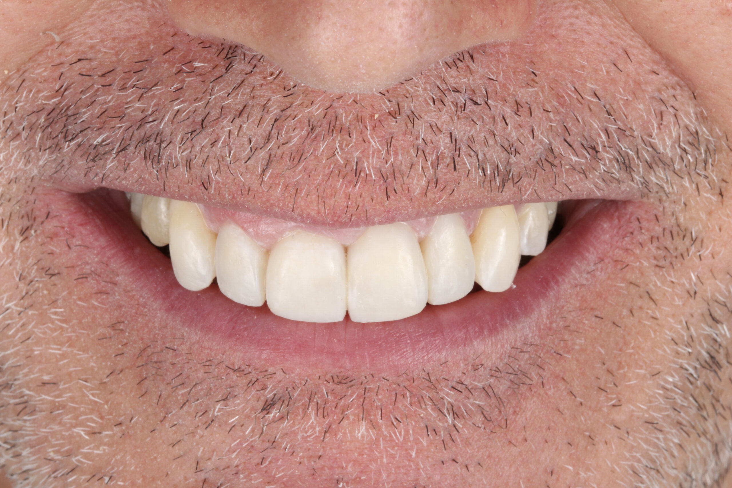 Caso real: Sonrisa renovada con ortodoncia, implantes y estética dental | Centro odontológico y formativo