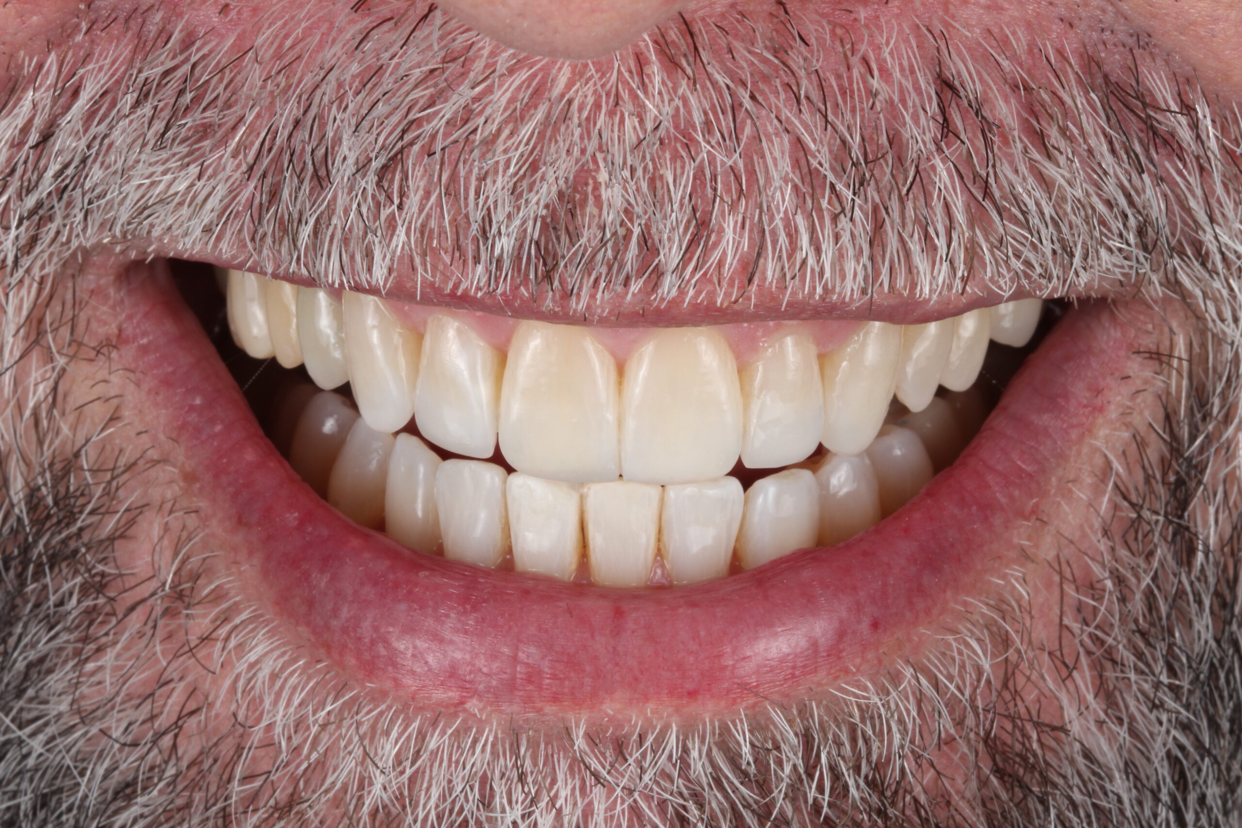 Caso Real: Transformación completa con ortodoncia, implantes y estética dental | Centro odontológico y formativo