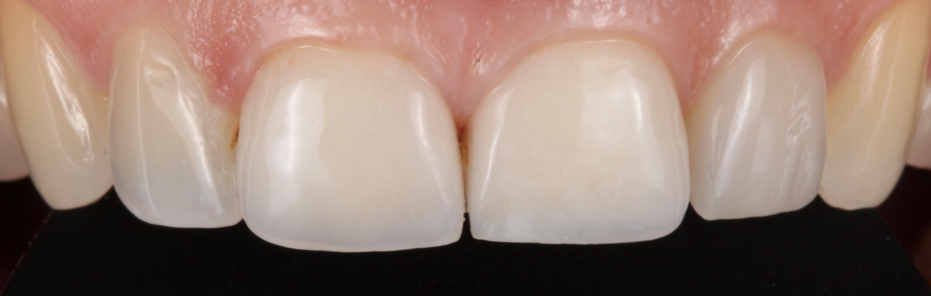 Cas Real: Perfeccionant l’harmonia d’un somriure amb carilles dentals | Centre odontològic i formatiu