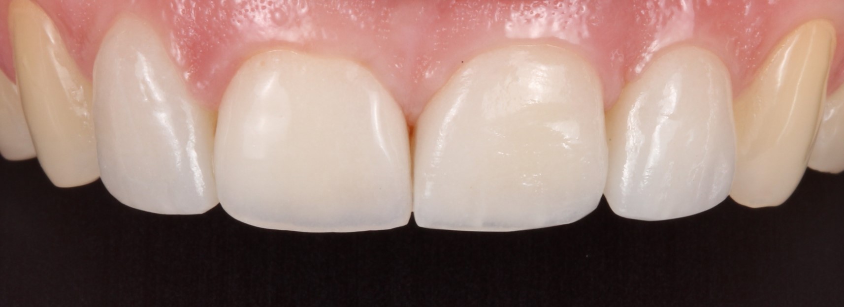 Cas Real: Perfeccionant l’harmonia d’un somriure amb carilles dentals | Centre odontològic i formatiu